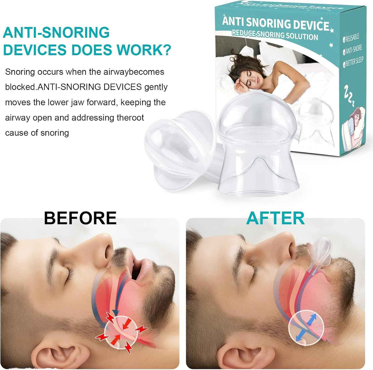 Anti Snoring Device - Tongue Retaining Mouthpiece