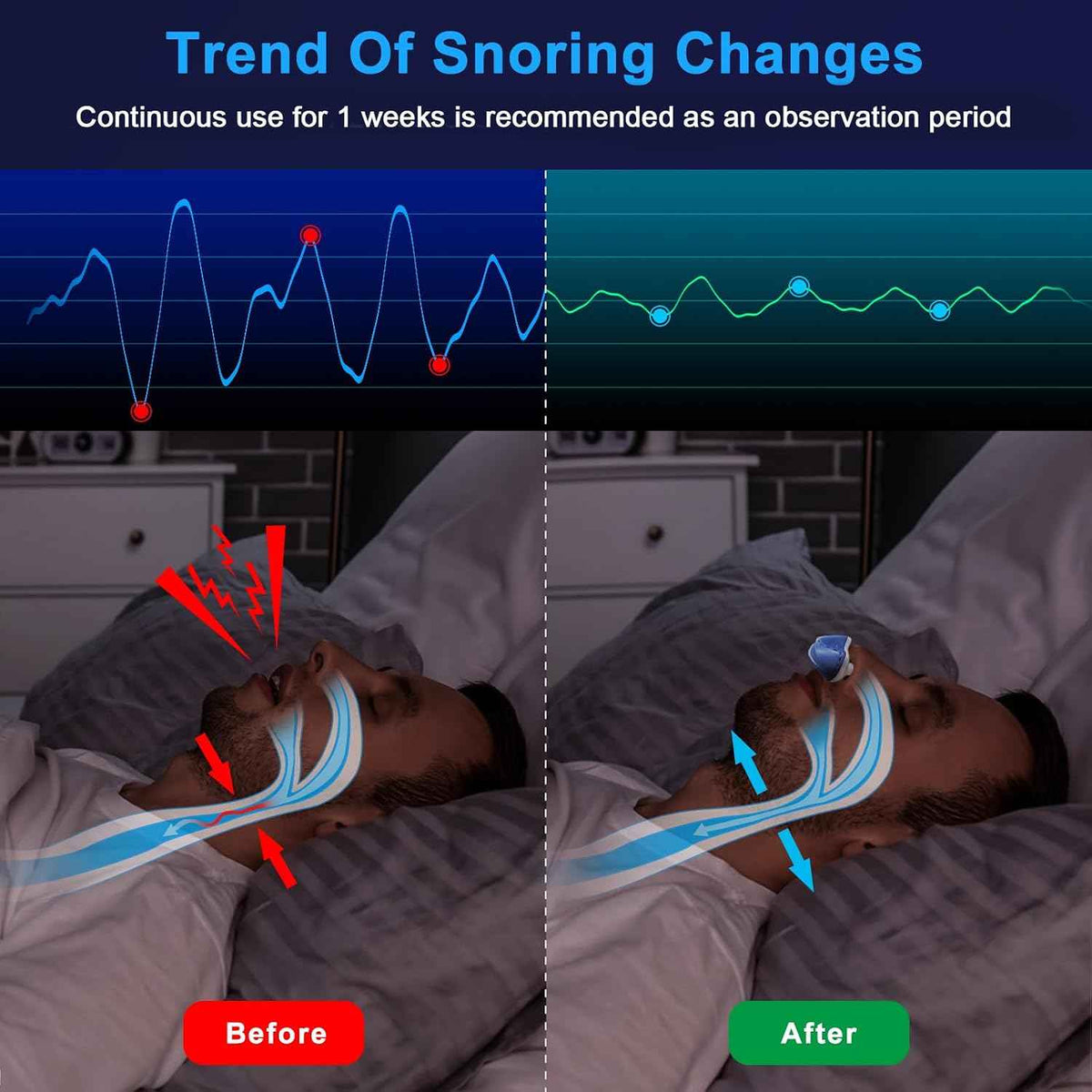 Anti Snoring Devices, Secure-Fit Snoring Solution with 3 Airflow Levels