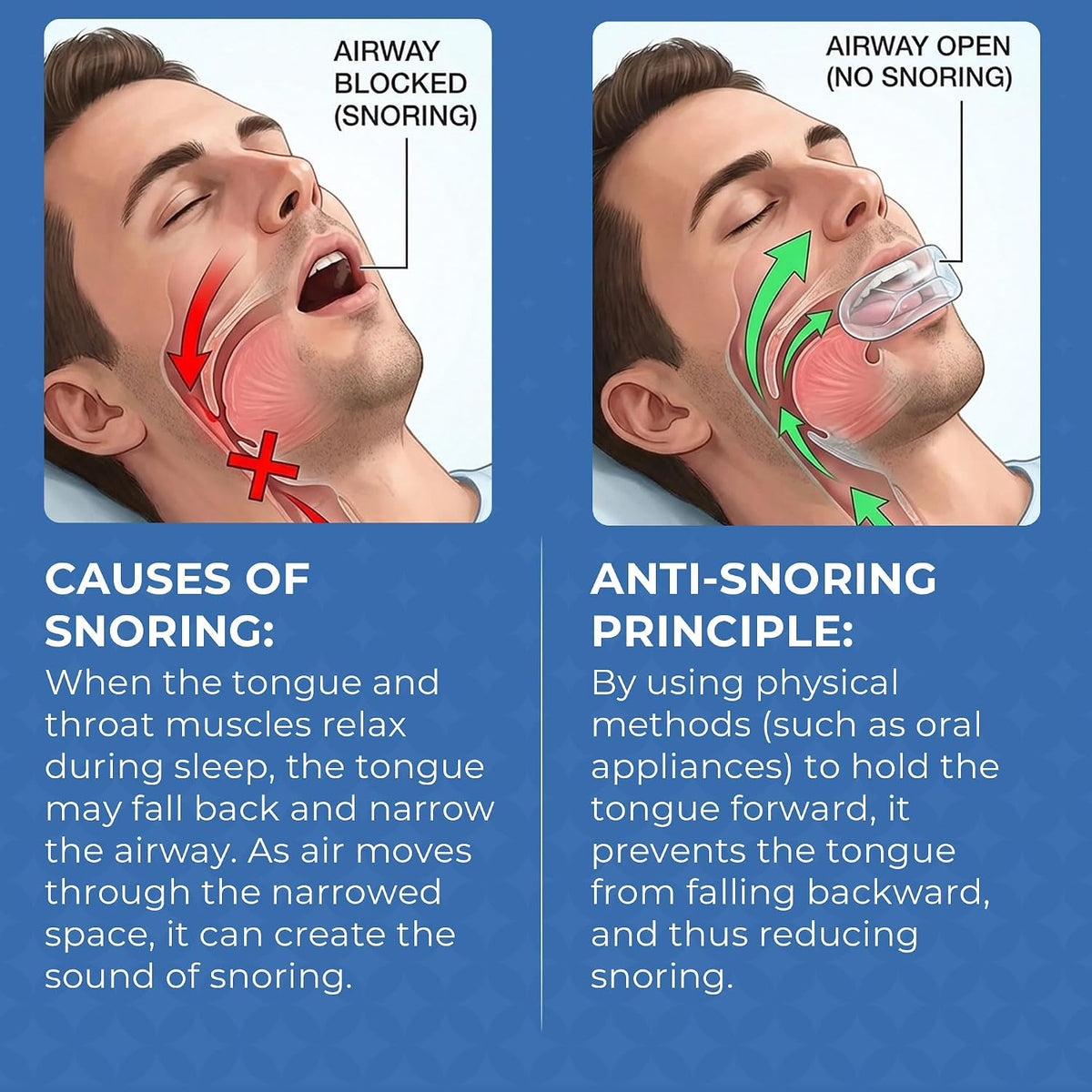 Anti Snoring Device: Clear RD-04